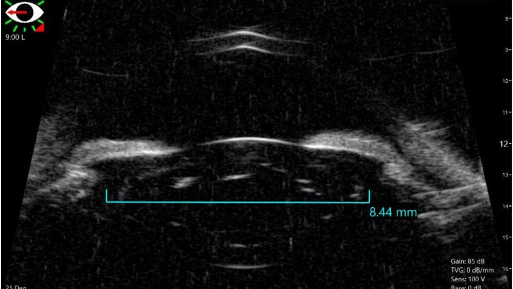 VuMax II Ultrasound Biomicroscopy (UBM) – for high resolution eye imaging